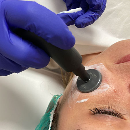 Tratamiento-de-radiofrecuencia-facial
