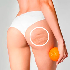 celulitis