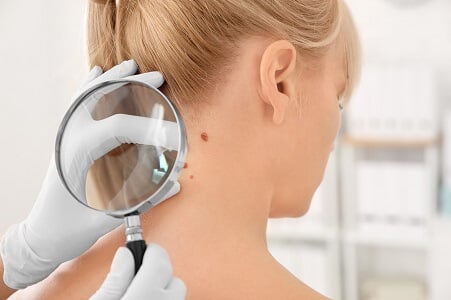 quitar-verrugas-con-laser